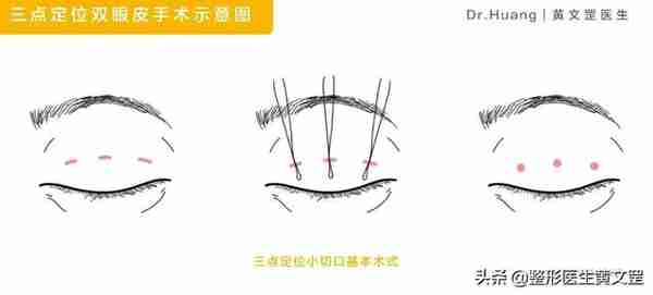 想做双眼皮?这些手术方式你会选吗?