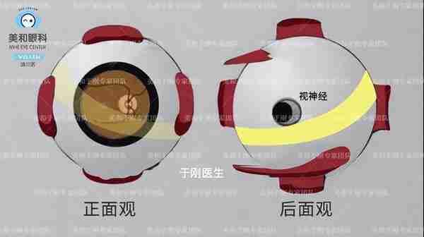 美和眼科|高度近视的“矛”与后巩膜加固的“盾”