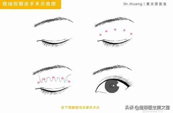 想做双眼皮?这些手术方式你会选吗?