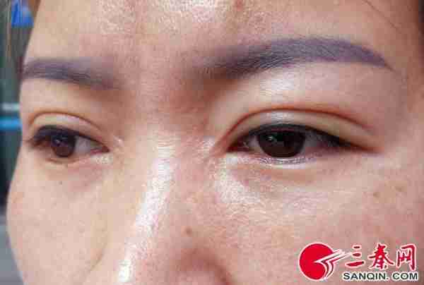 花钱美容反“毁容”双眼5个月没消肿 医疗美容师原来没资质
