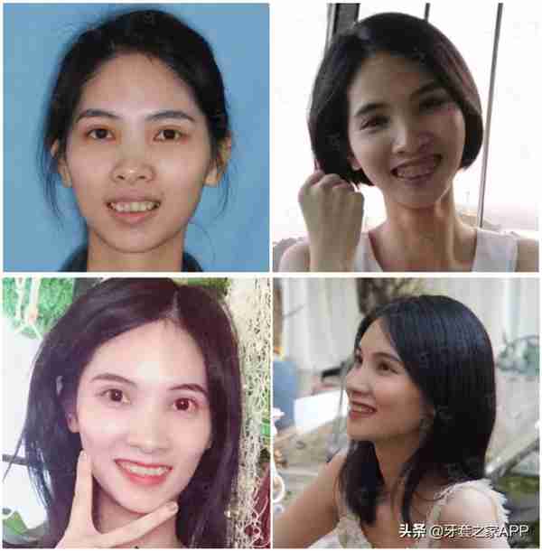 正畸分享|骨性前突、重度深覆合深覆盖、牙列不齐、严重露龈笑