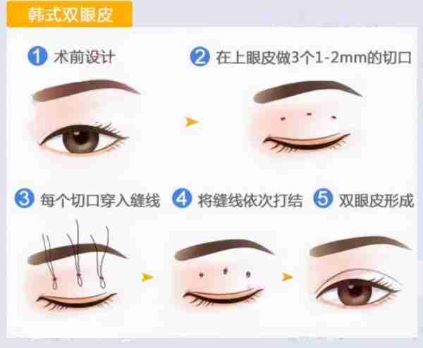 双眼皮手术类型常见的有三种,看完这篇文章,你就知道该怎么选了