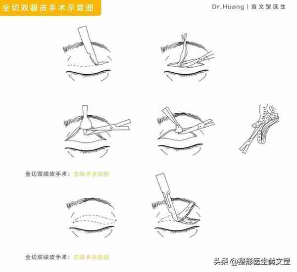 想做双眼皮?这些手术方式你会选吗?
