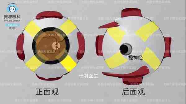 美和眼科|高度近视的“矛”与后巩膜加固的“盾”