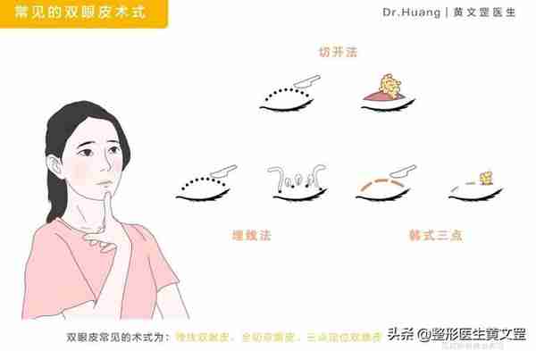 想做双眼皮?这些手术方式你会选吗?