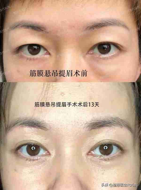49岁眼皮松弛做提眉还是全切双眼皮?女士选择提眉手术,术后13天