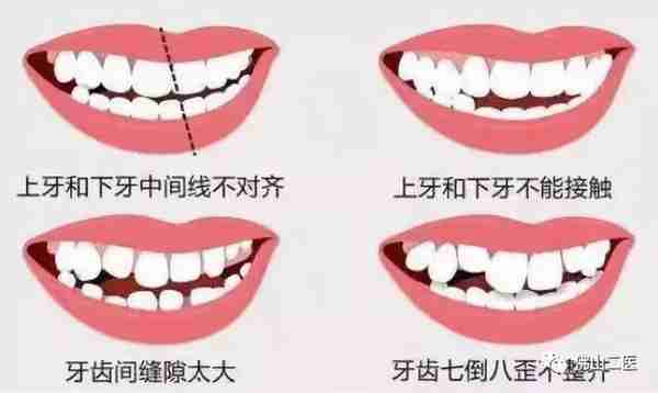 牙不齐不敢笑?抓紧这个时机去矫正,让你以后笑得更灿烂!
