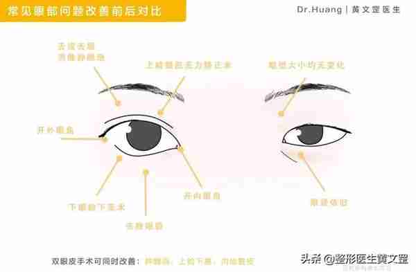 想做双眼皮?这些手术方式你会选吗?