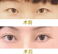 双眼皮手术类型常见的有三种,看完这篇文章,你就知道该怎么选了